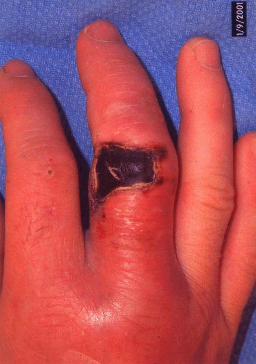 poisonous snake bite