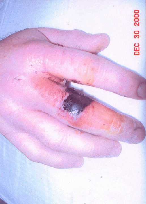 poisonous snake bite